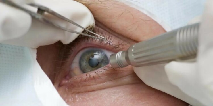 medicos-alertam-para-riscos-de-cirurgia-de-mudanca-da-cor-dos-olhos