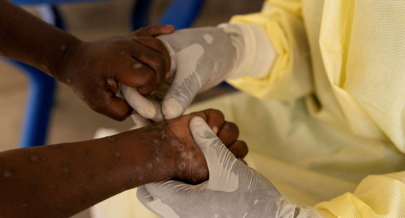saude-confirma-primeiro-caso-de-nova-cepa-de-mpox-no-brasil