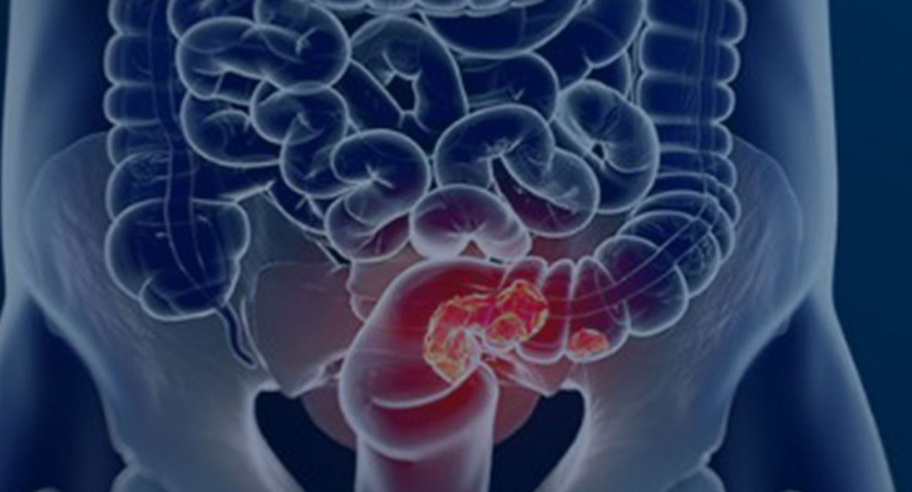 estudo-projeta-aumento-de-36%-em-mortes-por-cancer-colorretal-ate-2040