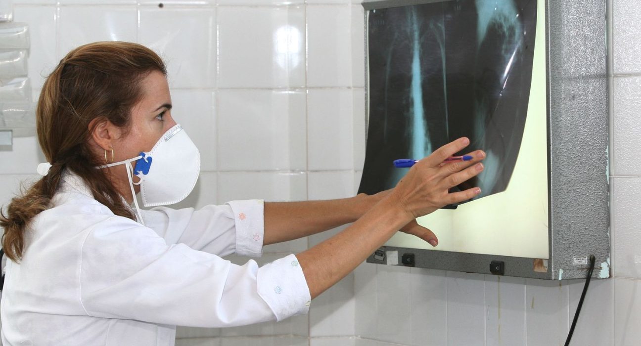 oms-recomenda-testes-de-diagnostico-rapido-para-erradicar-tuberculose
