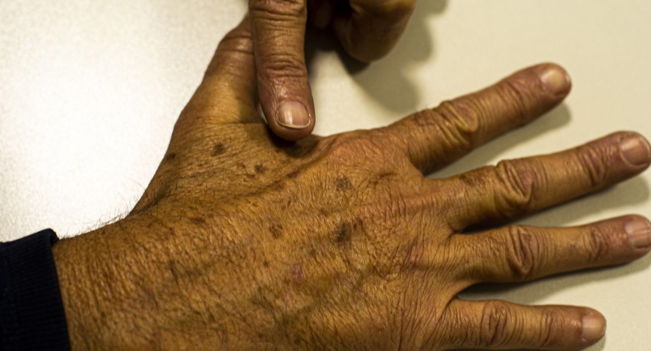 desinformacao-sobre-cancer-de-pele-afeta-diagnostico,-diz-instituicao