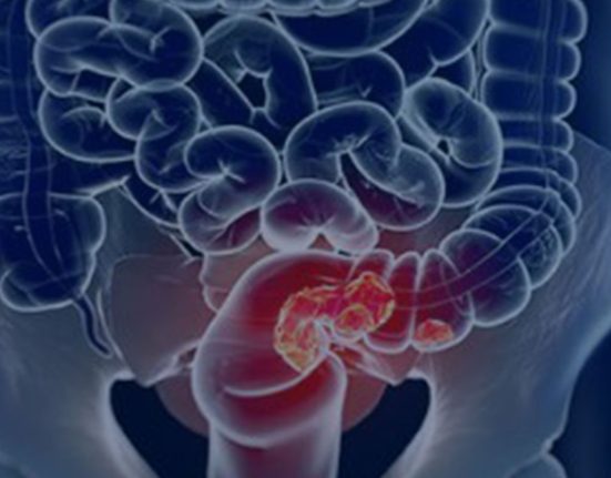 sus-adota-novo-exame-para-rastrear-cancer-colorretal-na-populacao